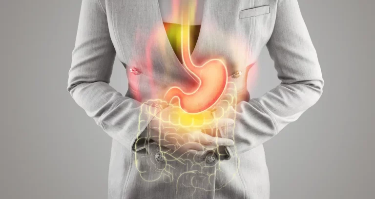 Acid Reflux