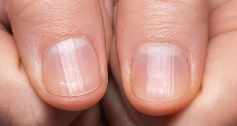 Horizontal Lines on Your Nails